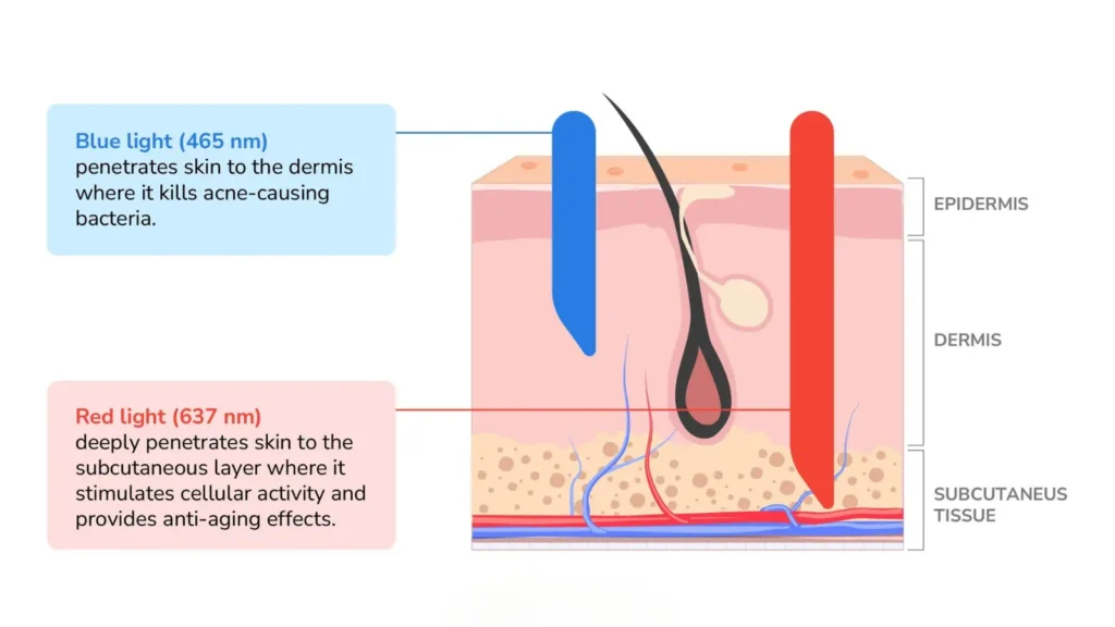 Affects of red and blue light on acne
